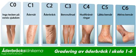 Ta bort åderbråck gratis